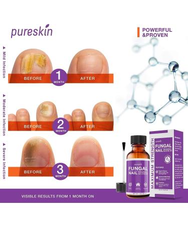 Toenail Fungus Revitalizer - Advanced Formula for Fast Relief & Healthy Nails - Buy Online on GoSupps.com