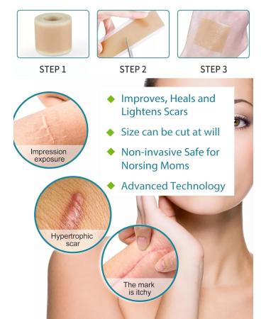 Big Size Silicone Scar Sheets - 3x60'' Roll for Effective Scar Removal | Reusable Silicone Scar Tape for All Types of Scars - Buy Online on GoSupps.com