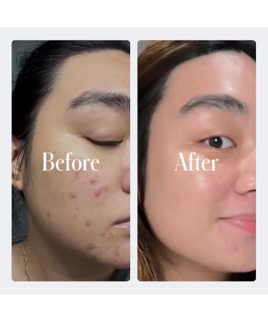 Geologie Clear System | 3-Step Acne Treatment Set for Men & Women | Fast Skin Clearing with Acne Gel Cleanser SPF15 Day Cream & Retinol Face Cream | Level 3 - 3pc - Buy Online on GoSupps.com