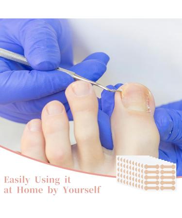 Ingrown Toenail Tool - 100Pcs Breathable Toenail Corrector Patches for Pain-Free Nail Straightening | Professional Ingrown Toenail Treatment - Buy Online on GoSupps.com