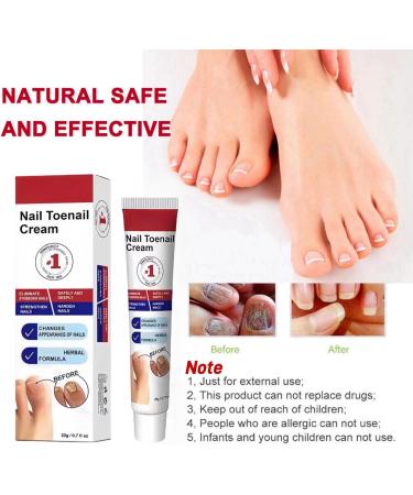 Fungal Nail Treatment Cream Antifungal Nail Polish Cream Nail Fungus Treatment for Toenail Strong Anti-Fungal Toenail Cream Nail Improve Cream Nail Repair Cream for Thick Cracked Discolored Nails - Buy Online on GoSupps.com