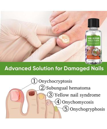 Extra Strength Toenail Fungus Treatment with Tea Tree Oil Extract - 30mL - Buy Online on GoSupps.com