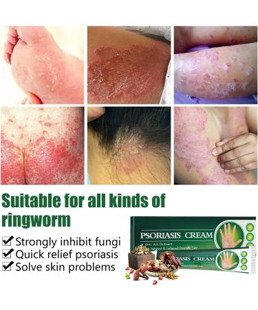  MagiSel Ringworm cream soothing anti-itch cream ready-to-use cream body cream for redness and itching relief skin itching relief - Buy Online on GoSupps.com