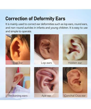 Sanfe Elephant Protruding Ear Corrector - Orthopedic Baby Item for Newborns - Pinna Locator for Large Ear Correction - Buy Online on GoSupps.com