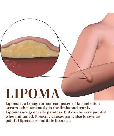 LumpFree Lipoma Cr me d maquillante instantan e au lipome cr me d maquillante aux lipomes aux herbes cr me v g tale naturelle pour liminer les grumeaux de lipome 20 g - Buy Online on GoSupps.com