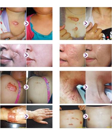 MQUPIN Silicone Scar Tape Roll (1.6 x 60 ) Silicone Scar Sheets Silicone Tape Reusable for C-Section Surgical Scar Keloid Acne Scar and Burn Scar - Buy Online on GoSupps.com