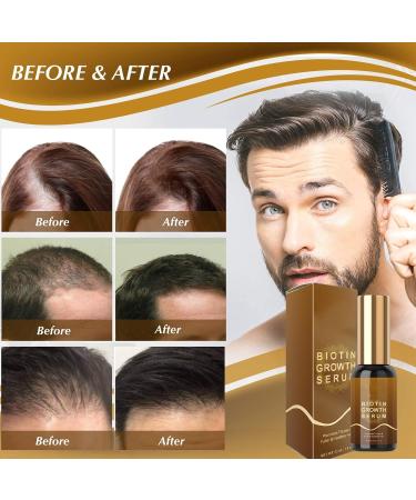 Hair Growth Oil Ginger Hair Regrowth Serum Anti Hair Loss Trengthen Hair Roots Hair Growth Serum for Hair Rapid Growth and Thickening Gifts for Men and Women 30ML - Buy Online on GoSupps.com