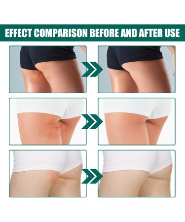 Shantou Yingji Acne cream for buttocks - Buy Online on GoSupps.com