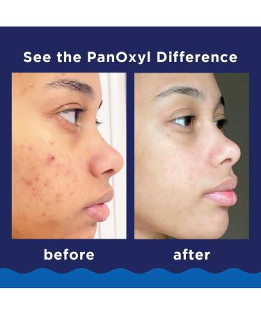 PanOxyl Foaming Acne Wash Maximum Strength 5.5 oz (Pack of 5) - Buy Online on GoSupps.com