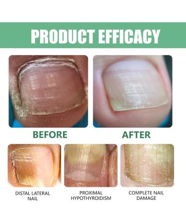 TUITUII Nail Care Pen nail care pen nail repair pen with tea tree oil vitamin E nourishes and soothes the nails strengthens the nail structure - Buy Online on GoSupps.com