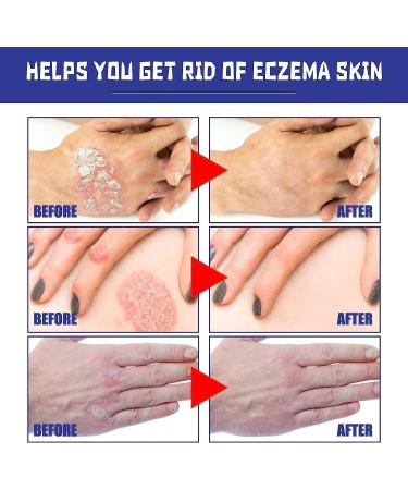 EXQST Herbal Psoriasis Relief Spray - Treatment for Skin Plaque Psoriasis (5pcs) - Buy Online on GoSupps.com