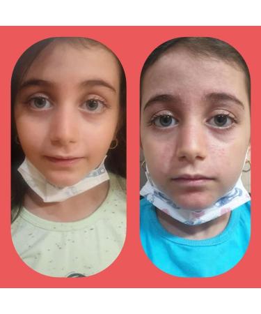 Demodexcillin Demodexcillin Skin Solution 4.0 Fl.Oz. Recommended for Rosacea Acne Belpharitis & Seborrheic Dermatitis - Buy Online on GoSupps.com