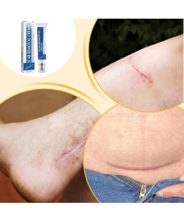 Scars Burns Cream - 30g Moisturizing Product for Scratching Marks - Reducing Cream for Old Scars - For Recovery of Cheloid Wounds Women Men Athletes - Buy Online on GoSupps.com