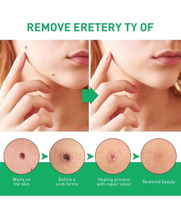 WATSKY Skin softening and foot care fluid for removing warts and corns gentle hypoallergenic formula 10 ml pack of 3 - Buy Online on GoSupps.com