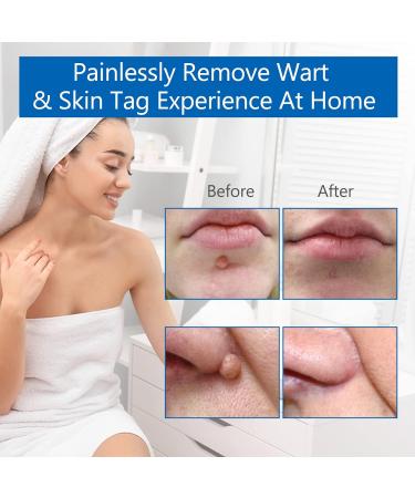 Skin Tag Removal - Auto Skin Tag Remover Pen Kit with 60 Micro and Regular Skin Tag Bands Fast and Easy Remover Wart and Mole(1mm-9mm) for Face and Body with 36 Skin Tag Removal Repair Patches - Buy Online on GoSupps.com