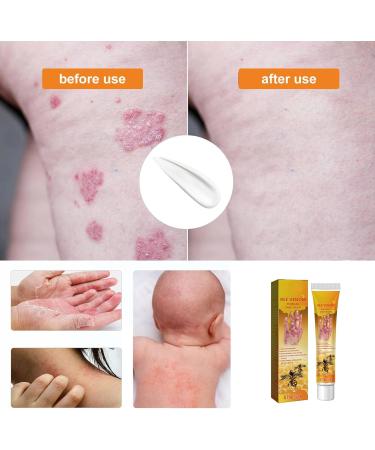 WOSLXM Bee Venom Psoriasis Treatment Cream - Professional Soothing & Moisturizing Formula for All Skin Types (3PCS) - Buy Online on GoSupps.com