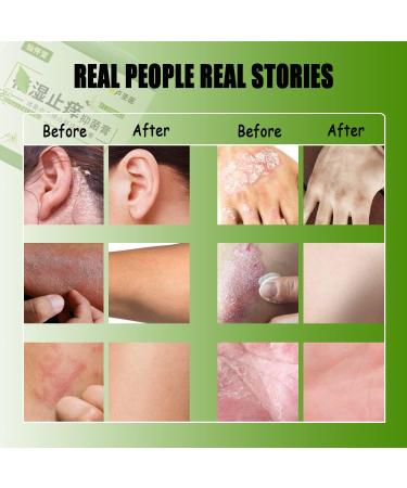 Natural Chinese Herbal Eczema Psoriasis Cream | Anti-Itch Dermatitis Treatment | Moisturizing Ointment for Red, Dry Irritated Skin (1.06oz) - Buy Online on GoSupps.com