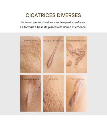 Scars Removal Cream 30g Natural Moisturizing Skin Care Body And Skin Cream For Morning Day Night Face Body Travel Home Piercing Scars Brands - Buy Online on GoSupps.com