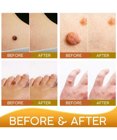 Samsali Skin Tag Remover Pads - 42 Count | Advanced & Effective Skin Tag Removal - Buy Online on GoSupps.com