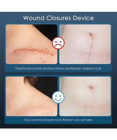 Wound Closure Strip 6 pcs - Sterile First Aid Kit Zip & Stitch Suture-Free Flexible Fabric Bandages for Skin Injury - Buy Online on GoSupps.com