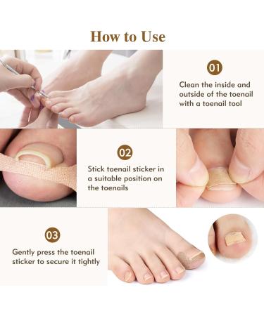 102Pcs Ingrown Toenail Kit Ingrown Toenail Corrector for Ingrown Toenail Treatment Including 80 PCS Ingrown Toenail Corrector 20 PCS C Shape Filling Pad and 2 Styles Ingrown Toenail Tools - Buy Online on GoSupps.com