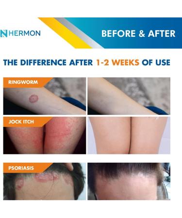 Hermon Antifungal Ringworm Cream - 100ml | Treat Ringworm Jock Itch Eczema & Athlete's Foot for Adults & Kids - Buy Online on GoSupps.com