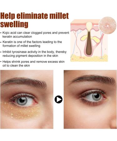 KOAHDE Speedy Milia Remover Eye Cream Milia Remover Eye Bags Cream Anti Wrinkle Eye Cream Milia Spot Treatment Eye Cream Dissolve and Reduce Milia Eye Cream Smooth Milia Eyes Cream 15G 2PC - Buy Online on GoSupps.com