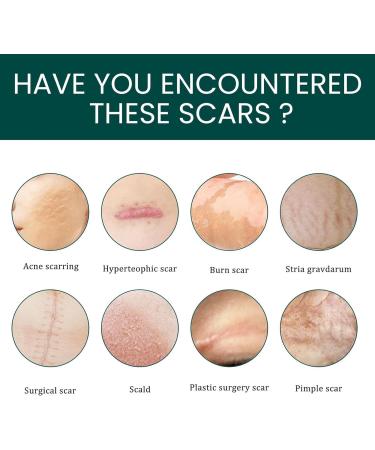 Teksome Silicone Scar Sheets - Stretch Mark Remover | Soften & Flatten Scars | For Surgery Injury Burns C-Section | 1.57*59 Inches - Buy Online on GoSupps.com
