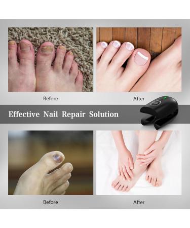 Nail Fungus Treatment for Toenails Light Therapy Fungus Highly Effective Cleaning Device 470 nm&660 nm Rechargeable Fungus Treatment for Fingernails and Onychomycosis Home Use (black) - Buy Online on GoSupps.com