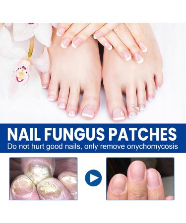 Fungal Nail Treatment Nail Repair Patches Nail Fungus Treatment for Toenail Fungal Nail Patches Extra Strong Nail Repair Treatment for Restores Damaged Nails - 32 Patches - Buy Online on GoSupps.com