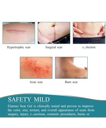 Meinuo Silicone Scar Sheets - Roll Scar Tape for Safe & Painless Scar Removal - 1.6 x 120 - Ideal for Body, Burn, C-Section, Keloid, Acne, Surgery - Buy Online on GoSupps.com