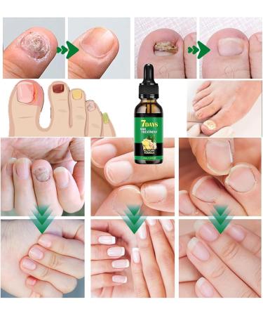 Ginger Nail Treatment Ginger Cuticle Care Oil for Nails | Nail Treatment Ginger Nail Nail Nail Care Nail Growth Serum Ginger Nail Serum Nail Nutrient Oil Strengthener Oil (2) - Buy Online on GoSupps.com