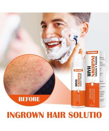 ApexFwdt Re ACT Exalted Minoxi Roll-On Hair Treatment Serum - Natural Nourishing Scalp Oil for Hair Growth and Repair - Women & Men - Buy Online on GoSupps.com