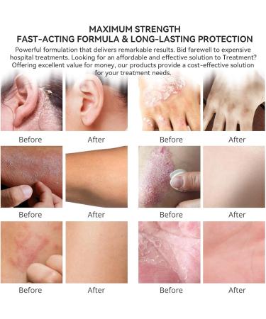 Itchy Feet Relief Cream | Soothing Treatment for Jock Itch Athlete's Foot Psoriasis & Eczema - 2 fl oz (Pack of 1) | Adult & Kids - Buy Online on GoSupps.com