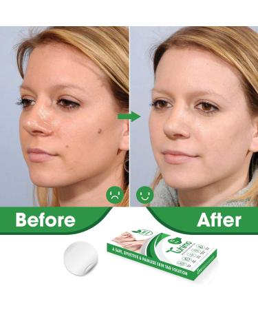 TUHIMO Pimple Patch Removal Device Pimple Remover for All Skin Types Herbal Condensed Patch for Small Large Pimples Wart - 72 Patches Bioclear Skin Tag Remover 1.0 count - Buy Online on GoSupps.com