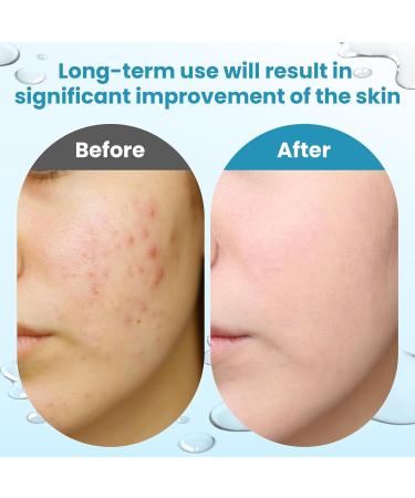 Glycolic Acid Resurfacing Pads, 15% Ultra Pure Glycolic Acid & 2% Salicylic Acid Exfoliating Peel for Face, Keeps Skin Smooth and Prevents Wrinkles and Lines, Radiant Skin Renewal - 60 Pads - Buy Online on GoSupps.com