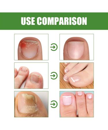 VKaoess Nail Care Roll On Stick Nail Strengthener for Damaged Nails Apply with Rollerball for Nail Care Prevents Skin and Supports Nail Health 2 Bottles - Buy Online on GoSupps.com