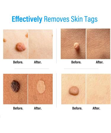 Zacurate Skin Tag Remover & Wart Mole Verruca Treatment Lotion - Fast-Acting Blue Formula - 30ML (Pack of 1) - Buy Online on GoSupps.com
