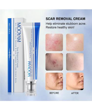 Advanced Scar Removal Cream for Face & Body - Effective Treatment for Keloids C-Section Surgery Burns & Acne - 30g/1.06 fl oz - Buy Online on GoSupps.com