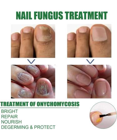 Antifungal Nail Treatment for Toe Fungus - 2-in-1 Solution to Treat and Prevent Nail Fungal Infections - Buy Online on GoSupps.com