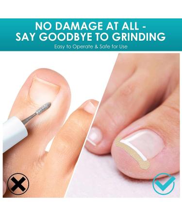 Professional Ingrown Toenail Treatment Kit - 60PCS Toenail Corrector Strips, File, and Lifter - Painless Pedicure Tool for Ingrown Toenails - Buy Online on GoSupps.com