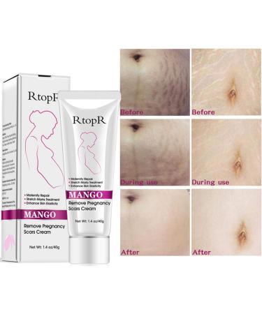 40G Remove Pregnancy Scars Scars and Acne Treatments for Pregnancy - Buy Online on GoSupps.com
