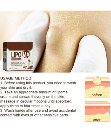 Anti-Lipomes Base de Plantes Lipoma Removal Cream Cr me D' limination Des Lipomes Cr me Naturelle D' limination des Lipomes Cr me Magique pour liminer les Lipomes 20G 1PC - Buy Online on GoSupps.com