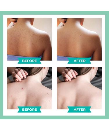 Tea Tree Oil Spray with 2% Salicylic Acid - Herbal Body Acne Treatment for Teens - Buy Online on GoSupps.com