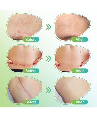 Silicone Scar Sheets & Tape - Medical Scar Removal Strips for Surgery Keloid C-Section Acne | Reusable | 1.6 x 120 Roll - Buy Online on GoSupps.com