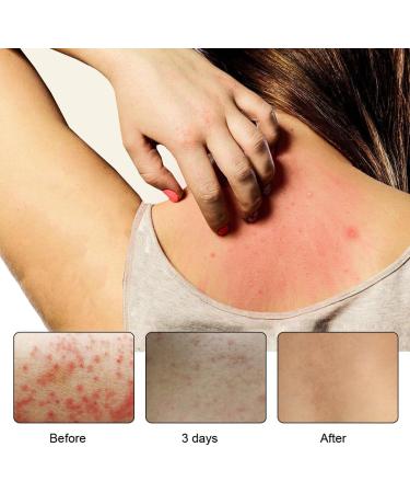 MCXNCXGD Dermatitis Inflammation and Rashes Body Cream 4 Count (Pack of 2) - Buy Online on GoSupps.com