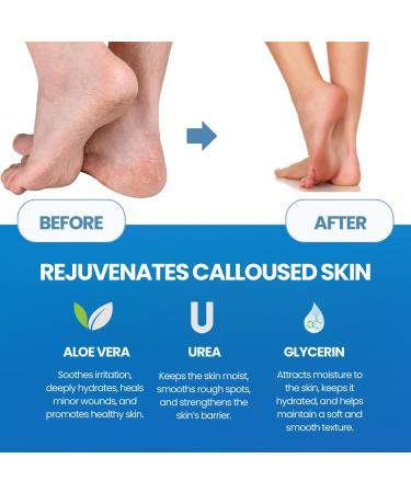 Callus Remover for Feet Extra Strength with Stainless Steel Foot File (Pedicure Grade) - Professional Foot Rasp Callus Remover Softener - Callus Treatment Heels and Hands - Cuticle Remover & Softener - Buy Online on GoSupps.com