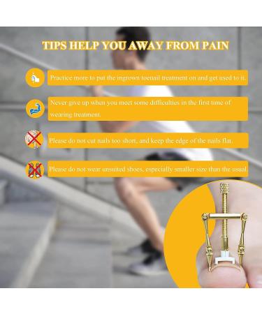 Ingrown Toenail Treatment Kit - Stainless Steel Corrector for Curved Toenails | Includes 12 Braces - Buy Online on GoSupps.com