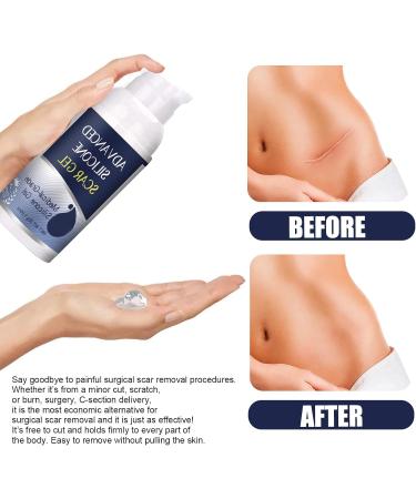 Silicone Scar Gel Anti Scar Cream Scar Elimination Scar Repair Gel Advanced Scar Remover For Caesarean Sections Stretch Marks Burns - Buy Online on GoSupps.com