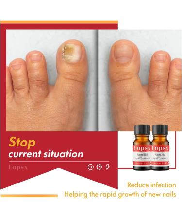 Mycose Ongles Des Pieds Lopsx Traitement Mycose Ongle Pied Puissant - Traitement Efficace pour Ongles Ab m s D color s et Fragiles 10ml - Buy Online on GoSupps.com